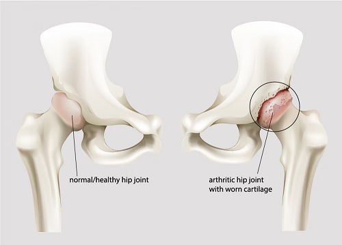 Hip Joint causes treatment