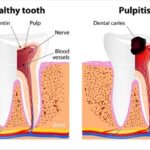 Milk tooth pulpitis