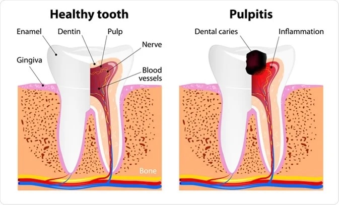 Milk tooth pulpitis