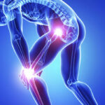 Other Bone And Joint Disorders