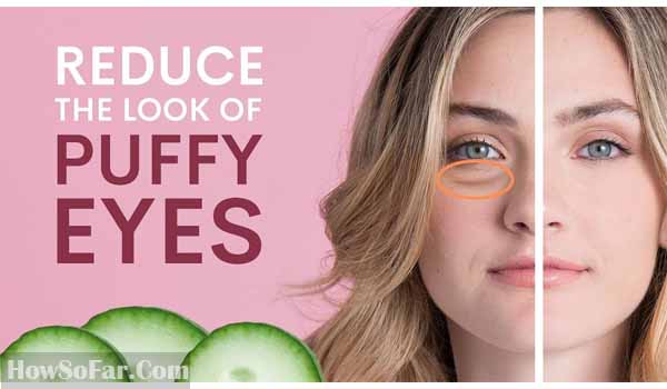 Eye Puffiness and Dark Circles